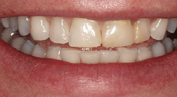 Before After3 Before